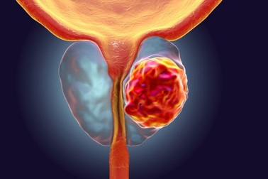 Dấu hiệu ung thư tuyến tiền liệt giai đoạn đầu