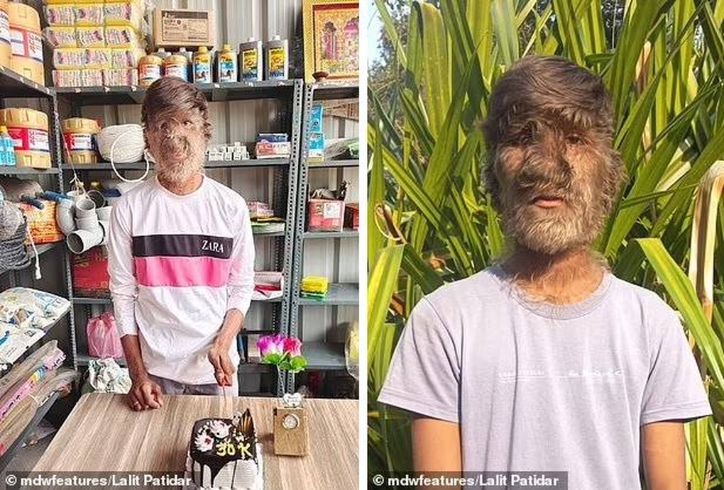 Ấn Độ: Nghị lực sống và tinh thần lạc quan của chàng trai người sói - 4 Ấn Độ: Nghị lực sống và tinh thần lạc quan của chàng trai người sói - 4