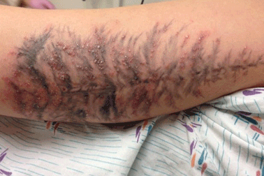 Rùng mình cảnh vết xăm mình bị mưng mủ