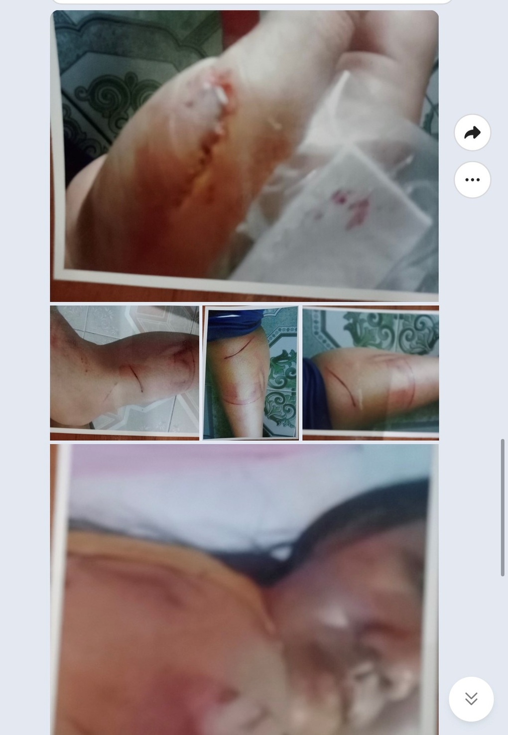 Bị bố ruột hành hung dã man, bé gái chạy trốn trong đêm - 2 Bị bố ruột hành hung dã man, bé gái chạy trốn trong đêm - 2