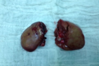 Cần Thơ: Cứu sống bệnh nhân bị xe tải cán vỡ thận 