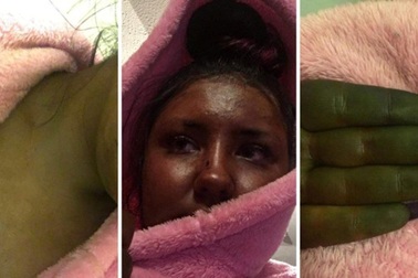 Dùng phải thuốc nhuộm "dỏm", da cô gái chuyển màu xanh