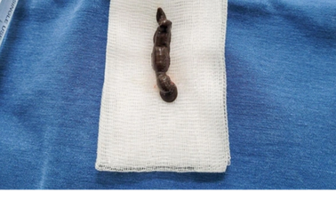 Con đỉa dài 5cm sống trong khí quản bé trai 5 tuổi