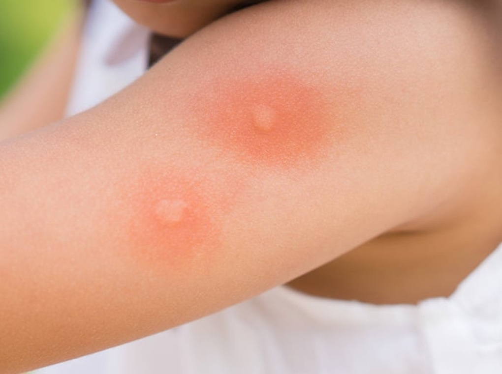 Vì sao một số người lại bị muỗi cắn nhiều hơn những người khác? - 1 Vì sao một số người lại bị muỗi cắn nhiều hơn những người khác? - 1