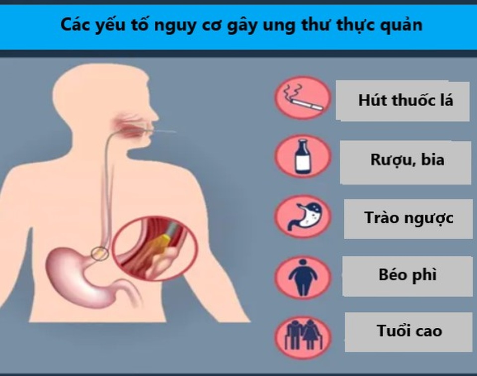 Những điều bạn cần biết để không lo lắng về ung thư thực quản - 1 Những điều bạn cần biết để không lo lắng về ung thư thực quản - 1