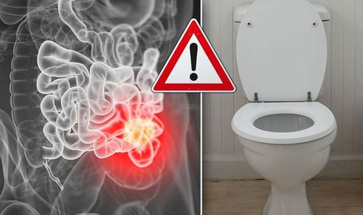 90% bệnh nhân ung thư đường ruột sẽ có những triệu chứng này khi đi vệ sinh - 1 90% bệnh nhân ung thư đường ruột sẽ có những triệu chứng này khi đi vệ sinh - 1