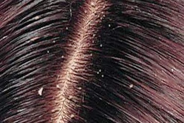 Bạn đã hiểu đúng về gàu?