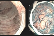 Dấu hiệu phổ biến giúp người phụ nữ phát hiện sớm ung thư trực tràng