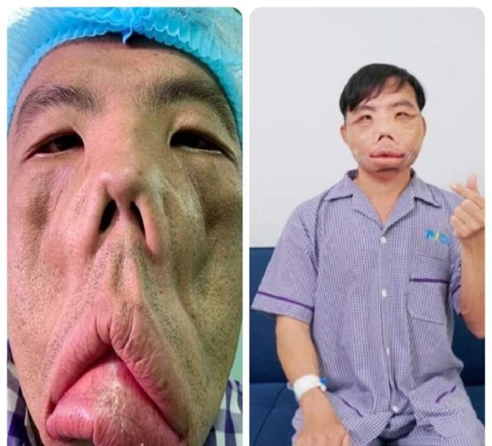 Người mang gương mặt quỷ, bí ẩn y khoa được giải mã - 2 Người mang gương mặt quỷ, bí ẩn y khoa được giải mã - 2