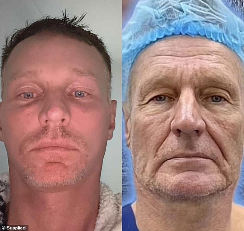 Західні туристи змінюють своє життя після приїзду до В'єтнаму на косметичну операцію - 2 Khách Tây đổi đời sau khi tới Việt Nam phẫu thuật thẩm mỹ - 2