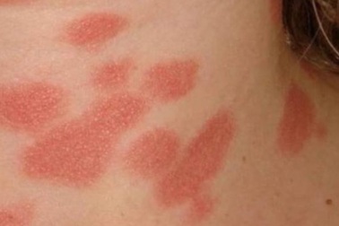 Những phản ứng da liễu nào có thể xuất hiện sau tiêm vaccine Covid-19?