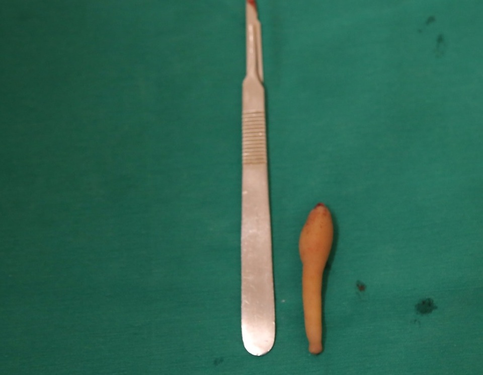 Kỳ lạ bé gái 5 tháng tuổi có đuôi vùng xương cụt dài gần 10cm - 2 Kỳ lạ bé gái 5 tháng tuổi có đuôi vùng xương cụt dài gần 10cm - 2