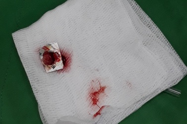 Người đàn ông bị kẹt vỏ thuốc trong khí quản hơn một năm