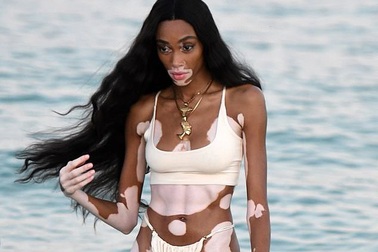 Winnie Harlow sexy với bikini