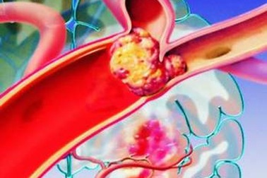 Thuyên tắc huyết khối tĩnh mạch, biến chứng nguy hiểm trên bệnh nhân ung thư