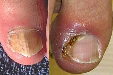 Ẩn họa từ làm đẹp móng 