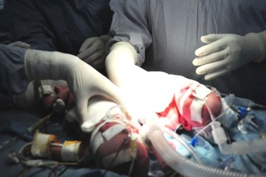 Kịch tính “căng não” trong ca tách cặp song sinh dính ngực