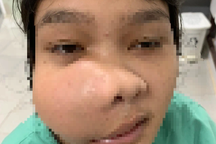 Nữ bệnh nhân bị khối u xoang hàm kéo lệch mặt