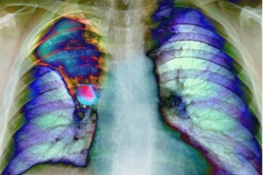 Tỉ lệ phụ nữ mắc ung thư phổi tăng 73%