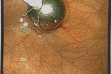 Ăn bánh sinh nhật, chân nến sắc nhọn chui tọt vào thực quản bé gái 6 tuổi.