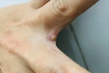 Sức khỏe bệnh nhân mắc đậu mùa khỉ đầu tiên tại Việt Nam hiện ra sao?