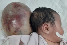 Cắt khối u khổng lồ như cái đầu thứ 2 cho bé sơ sinh