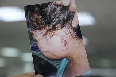Cắn người đứt tai, thoát tội nhờ quy định mới