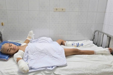 Bác sĩ kêu gọi giúp đỡ cậu bé lớp 9 bị cắt cụt 2 tay và 1 chân vì bỏng điện