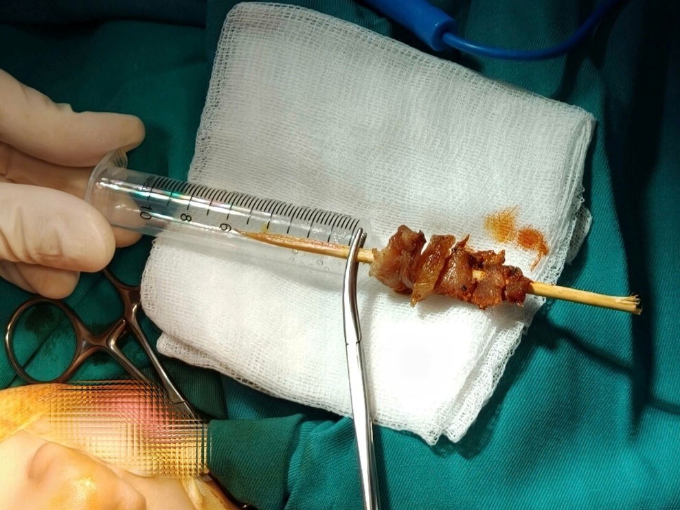 Bé gái 2,5 tuổi bị que xiên thịt đâm xuyên hốc mắt - 3