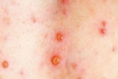 Nam bệnh nhân 36 tuổi ở Cà Mau dương tính bệnh đậu mùa khỉ