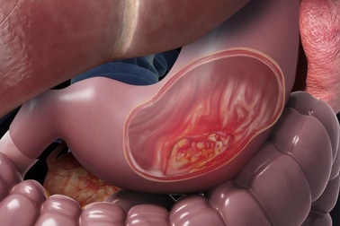 Đề phòng bệnh tiêu hóa tiến triển thành ung thư