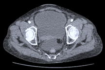 TPHCM: Người phụ nữ nguy kịch vì vỡ bàng quang 10 ngày mà không biết