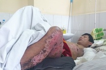 Người đàn ông bị điện giật sém nửa người: Trách nhiệm thuộc về ai?