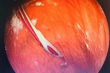 Bệnh nhân nuốt trọn bàn chải đánh răng vì tự “giải cứu” khi hóc xương cá