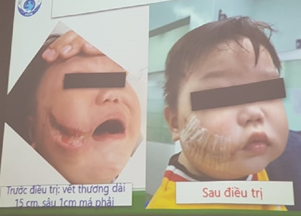 Đang ăn xúc xích, bé trai bị chó tấn công cướp đồ ăn, cắn vùng đầu mặt - 3 Đang ăn xúc xích, bé trai bị chó tấn công cướp đồ ăn, cắn vùng đầu mặt - 3