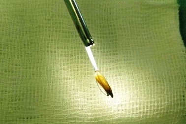 Hy hữu, người đàn ông nhập viện vì bị hạt thóc mắc kẹt trong dương vật