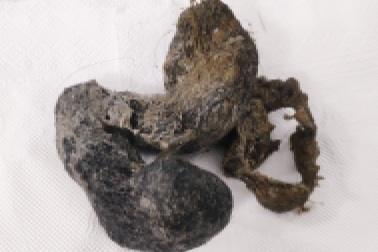 Ám ảnh lọn tóc khổng lồ quấn chặt dạ dày bé gái 4 tuổi vì hội chứng kỳ lạ