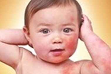 Tìm hiểu về dị ứng đạm sữa bò ở trẻ