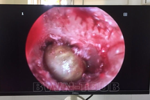 Gắp dị vật ve chó còn sống trong tai bé gái 2 tuổi