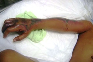 Bị rắn hổ mèo cắn, bé trai suýt mất mạng 