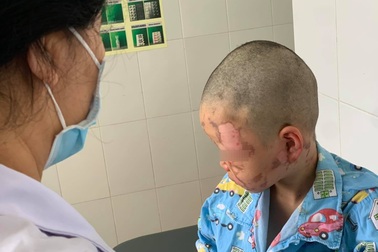 Bé 10 tuổi bỏng nặng vùng mặt vì nghịch dại theo video trên mạng