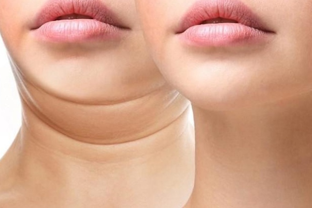 Nhiều người đau đớn, biến dạng da vùng mặt sau khi tiêm xóa mỡ nọng cằm - 3 Nhiều người đau đớn, biến dạng da vùng mặt sau khi tiêm xóa mỡ nọng cằm - 3