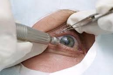 74% trường hợp mù do đục thủy tinh thể