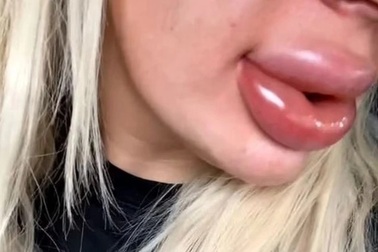 Môi sưng lên gấp 20 lần sau điều trị tan chất làm đầy