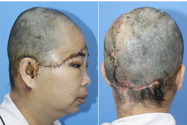 Nữ bệnh nhân bị lột da đầu được ghép da ngoạn mục