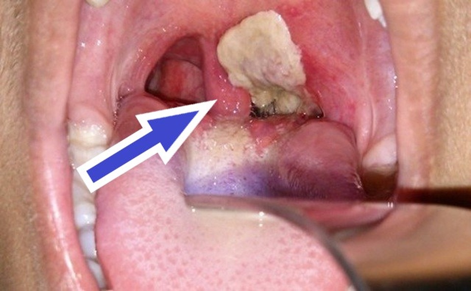Bạch hầu dễ bị nhầm thành viêm họng: Phân biệt 2 bệnh này như thế nào? - 4 Bạch hầu dễ bị nhầm thành viêm họng: Phân biệt 2 bệnh này như thế nào? - 4