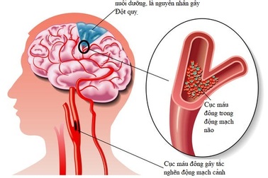 Những cách giúp người bệnh rung nhĩ sống lâu, sống khỏe hơn