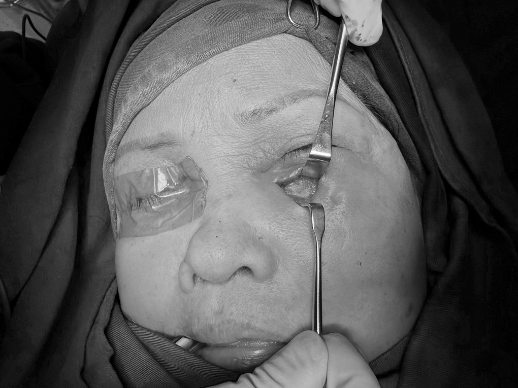 Hoại tử mi mắt vì spa tiêm ống oxy già tẩy trắng răng để làm đẹp - 2