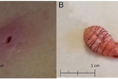 Mỹ: Phát hiện dòi ăn thịt làm tổ trong chân vì bị côn trùng cắn