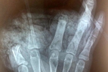 Thiếu niên 14 tuổi bị cụt 3 ngón tay vì nghịch pin quạt tích điện